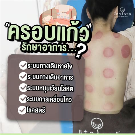 win888lotto|ข้อควรปฏิบัติในการรักษาด้วยการครอบแก้ว.